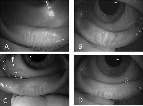 Meiboscore. Partial or complete loss of meibomian glands is graded from... | Download Scientific ...