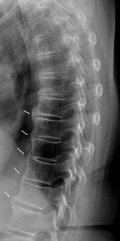 Hyperostosis, Diffuse Idiopathic Skeletal; Forestier Disease; Vertebral Ankylosing Hyperostosis ...