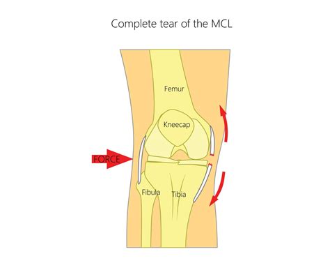 Medial Collateral Ligament (MCL) Tears | Upswing Health