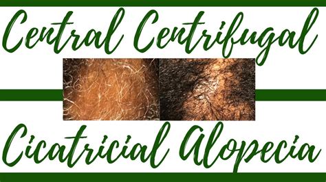 Central Centrifugal Cicatricial Alopecia | Day 4 - YouTube