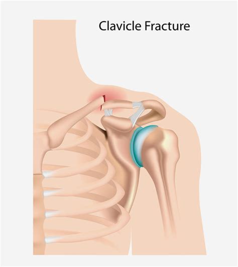 4 Treatment Options And Causes Of Broken Collarbone In Kids