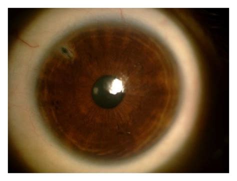 The iridocorneal angle is Grade 1 according to Shaffer classification. | Download Scientific Diagram