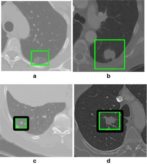 Examples of different types of lung nodules. a ground-glass nodule with... | Download Scientific ...