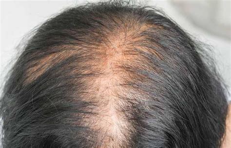 Androjenik Alopesi - Nedenleri, Tedavisi ve Daha Fazlası Alopesi Nedir ...