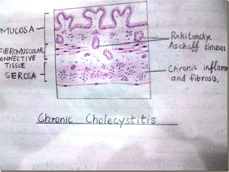 Histology Slides Database: Chronic Cholecystitis histopathology diagrams