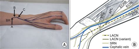 Distribution of superficial radial nerve (A) and cephalic vein (B) in... | Download Scientific ...