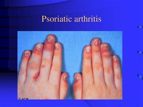 PPT - Psoriatic arthritis PowerPoint Presentation, free download - ID ...