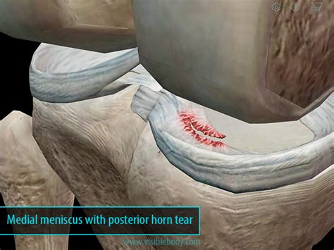 Large Posterior Horn Medial Meniscus Tear