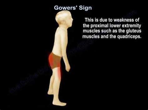 Gower's Sign - YouTube