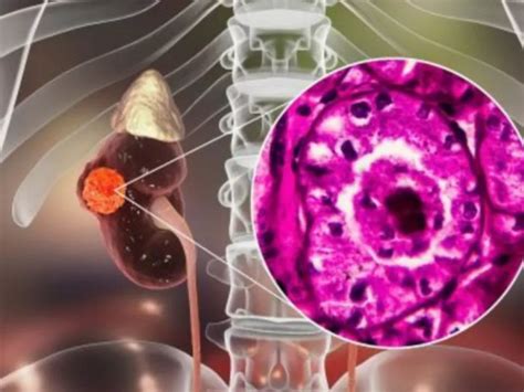 Understanding the Stages of Advanced Renal Cell Carcinoma - PharmRx-1: Your Comprehensive ...