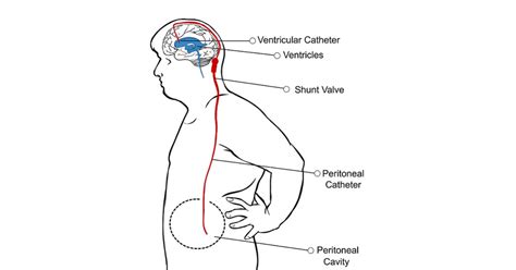 VP Shunt: Purpose, Preparation, Procedure, Aftercare, Results, Risks ...