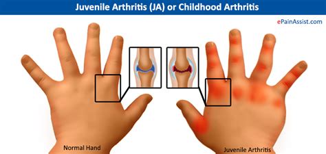 Juvenile Arthritis (JA) or Childhood Arthritis|Symptoms|Treatment-NSAIDs, PT