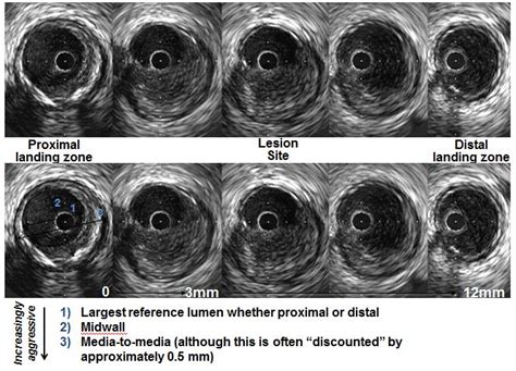 IVUS in PCI Guidance - American College of Cardiology