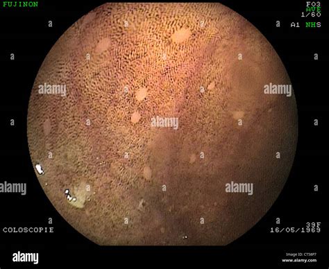 MELANOSIS COLI, ENDOSCOPY Stock Photo - Alamy