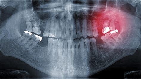 Mercury is toxic, but is still used in amalgam fillings | South China Morning Post