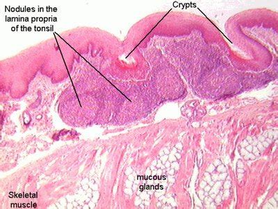 Lingual Tonsils - Tonsillitis and Pictures