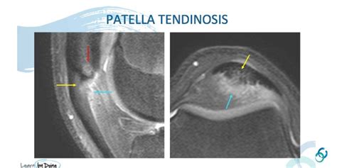 Patellar Tendon Tendinopathy