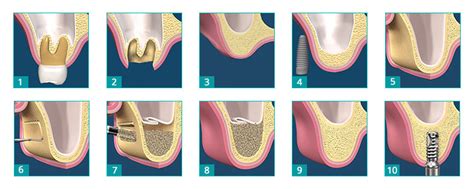 Sinus Lift or Maxillary Sinus Floor Augmentation