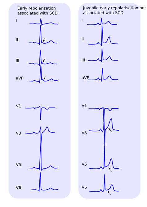 Repolarization (ST-T,U) Abnormalities - ECGpedia