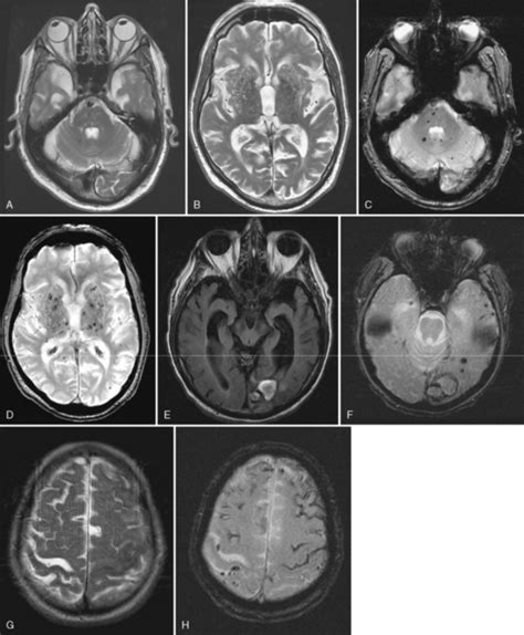 Vascular Diseases of the Brain | Neupsy Key