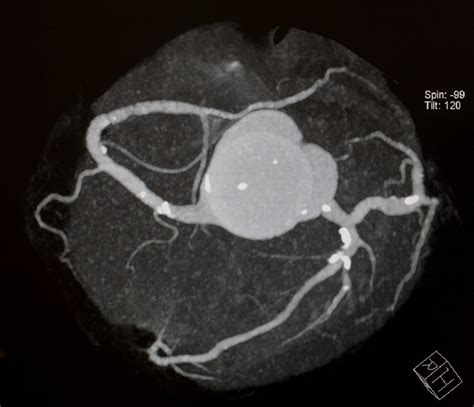 CT Calcium Scoring | Cardiology Consultation - Dr Arthur Nasis