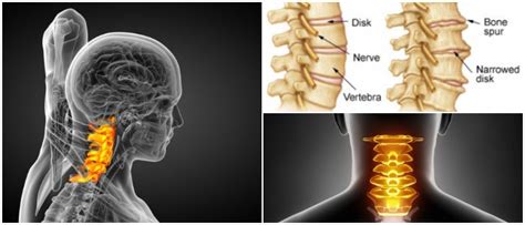 Cervical Spondylosis: Causes, Symptoms and Treatment - Hoool Health & Wellness