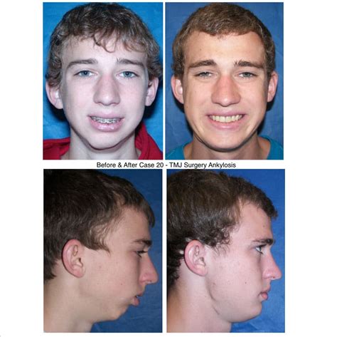 Before and After Photos Maxillofacial Surgery - Larry M. Wolford, DMD