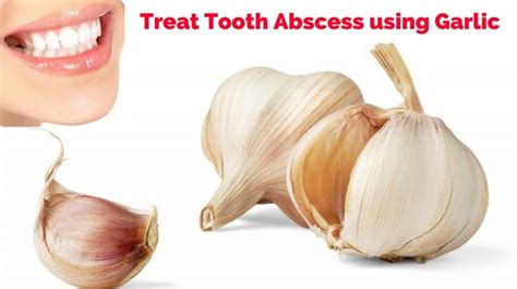 How to Treat Tooth Abscess using Garlic