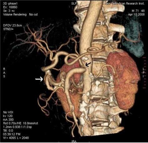 Celiac artery stenosis (black arrow) with tortuous pancreaticoduodenal ...