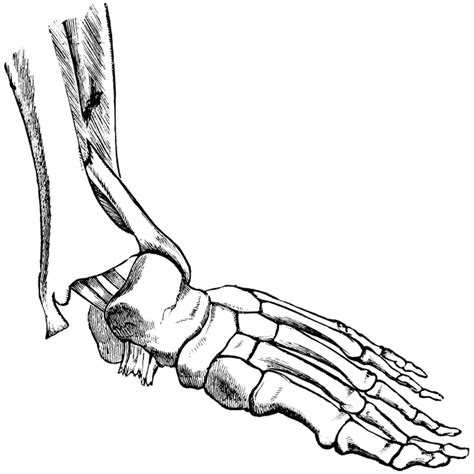 Bone Fracture Clipart - ClipArt Best