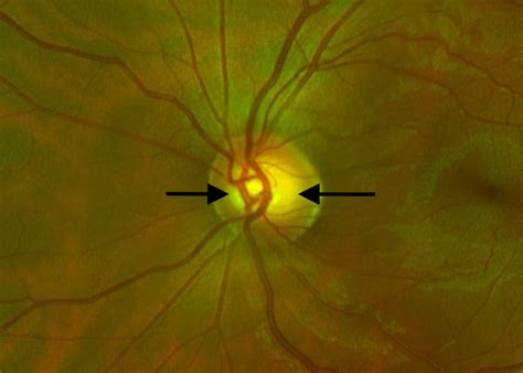 Glaucoma Suspect