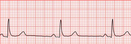 Bradycardia - Physiopedia