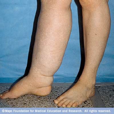 Lymphedema - Fluid Retention And Swelling - Vein Specialists of the ...