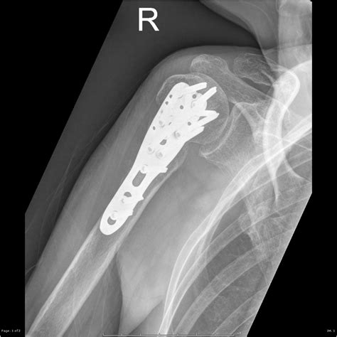 Proximal Humerus Surgical Neck Fracture