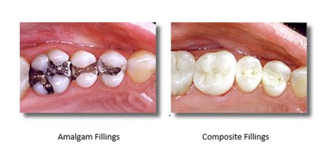 Can I Whiten Teeth With Fillings? | Poplar Crossing Dental