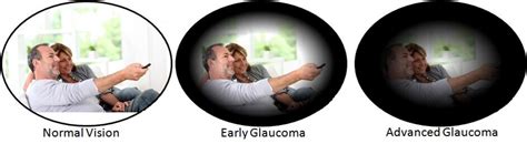 Glaucoma Management - Kirby Eye CenterKirby Eye Center