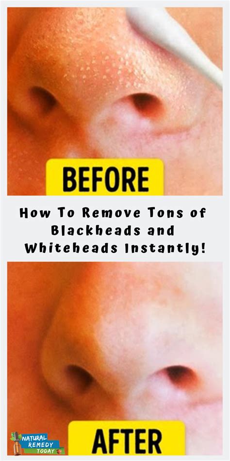 How To Remove Tons of Blackheads and Whiteheads Instantly! | Acne on ...