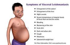 Visceral Leishmaniasis Symptoms | Visceral Leishmaniasis Symptoms Signs ...