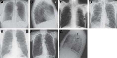 Xray Interpretation Copd Youtube