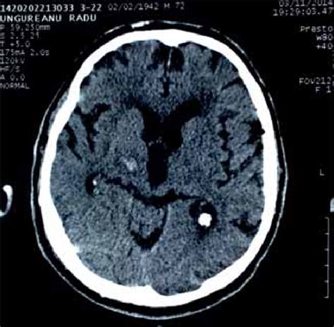 Brain CT showing a hyperdense lesion at the level of the right... | Download Scientific Diagram