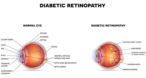 Diabetic Macular Edema Baltimore, Pikesville, Glen Burnie, & Owings Mills