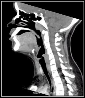 What Is A Ct Scan With Contrast Of The Neck