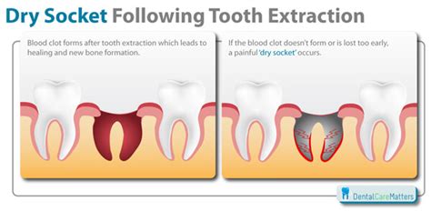 Dry Socket | Oral Surgery | Dentist Beaufort SC | Ladys Island Dentist