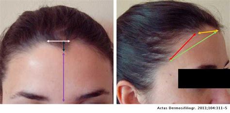 M Shaped Hairline - Shaping the hairline and adding lots of lines and ...