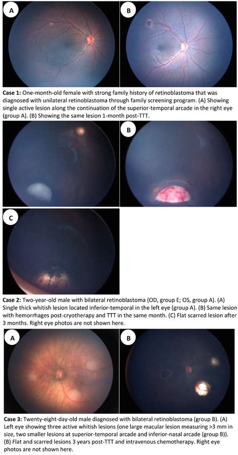 Retinoblastoma: Update on Current Management | IntechOpen