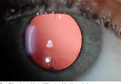 Figure 2 from Toric Intraocular lenses in cataract surgery | Semantic ...