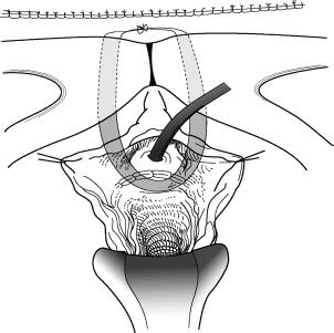 Pubovaginal Fascial Sling for the Treatment of all Types of Stress Urinary Incontinence ...