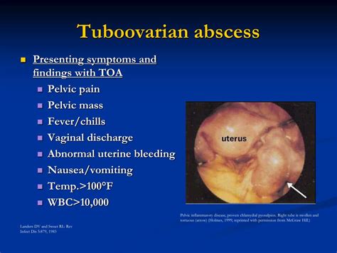 PPT - Pelvic Inflammatory Disease PowerPoint Presentation, free ...