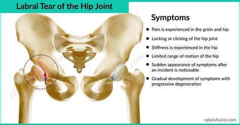 Labral Tear of The Hip Joint-Know Its Causes, Symptoms, and Treatment | Labral tear | Torn ...