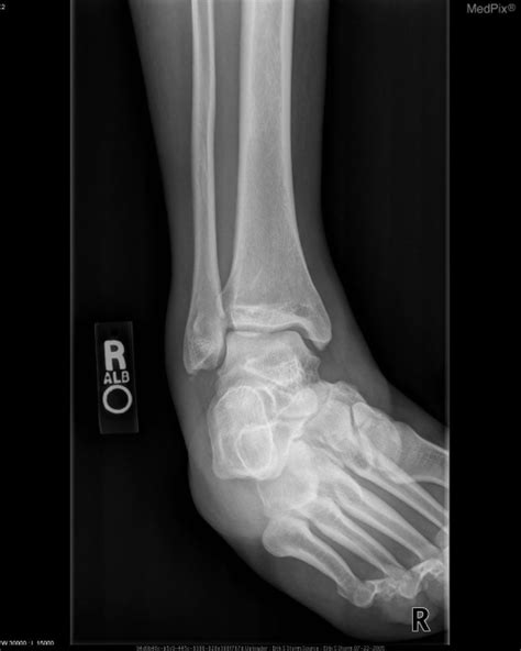 Mortise view of the ankle demonstrates normal alignment | Open-i